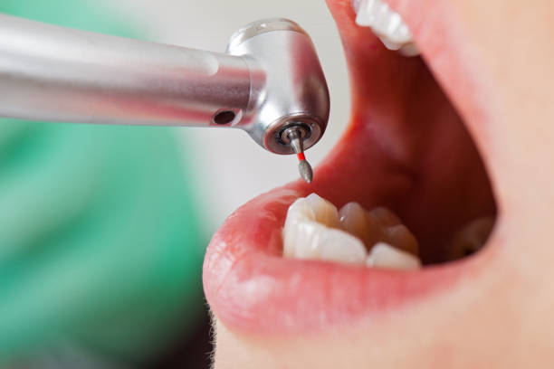 Best Emergency Root Canal Treatment in Spencerville, OH